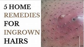 5 Home Remedies For Ingrown Hairs