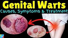 Genital Warts – Symptoms, Causes, Pathophysiology, Diagnosis, Treatment, Complications, Preventions