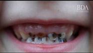 Child tooth decay in Northern Ireland