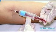SANLI Medical: Flashback Needle