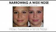 Narrowing Wide Nose - Rhinoplasty