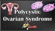 Polycystic Ovarian Syndrome (PCOS) - Causes, Signs & Symptoms, Diagnosis & Treatment
