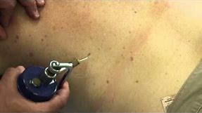 How to treat multiple Seborroheic Keratosis Warts on the back using Cryotherapy
