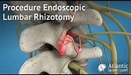 Procedure Endoscopic Lumbar Rhizotomy