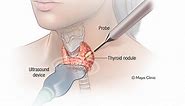 Mayo Clinic Minute: Treating thyroid nodules without surgery - Mayo Clinic News Network