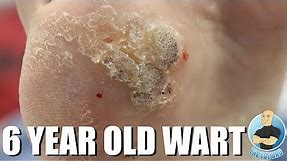 REMOVING A 6 YEAR OLD HUGE THICK PLANTAR WART