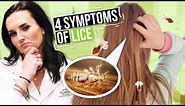 Head Lice Symptoms and Treatment - 4 Signs of Lice to Watch For