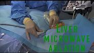 Liver microwave ablation of a sub capsular HCC with Ultrasound