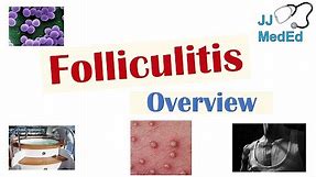 Folliculitis | Causes (Bacterial, Fungal, Viral), Risk Factors, Symptoms, Diagnosis, Treatment