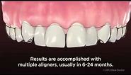 ClearPath Aligners - NEW VIDEO for PATIENT EDUCATION by AACD