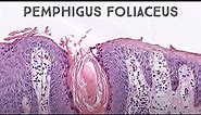Pemphigus foliaceus (autoimmune skin blister immunobullous disease in pemphigus vulgaris family)
