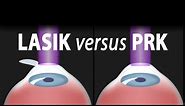 LASIK or PRK? Which is right for me? Animation.