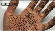 EXTREME Trypophobia Hand!! Trypophobia Disease Is Real Or Fake | December 2017_ 18