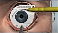 LASIK eye surgery - 3D animation