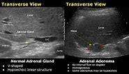 Adrenal Gland Ultrasound Normal Vs Abnormal Image Appearances | Cyst, Adenoma, Pheochromocytoma USG