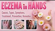 Eczema on Hands Causes, Types, Pictures, Symptoms, Treatment, Natural Remedy | Hand Dermatitis