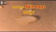Why do I suddenly have skin tags? Are they dangerous? - Dr. Rasya Dixit