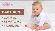 Baby Acne – Causes, Symptoms & Treatment