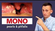Infectious Mononucleosis (Mono) Symptoms, Diagnosis, and Treatment