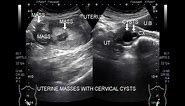 Ultrasound Video showing Multiple fibroids with cervical cysts.