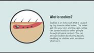 Scabies: Signs, Symptoms, Causes, and Treatment | Merck Manual Consumer Version