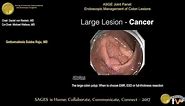 The large colon polyp: When to choose EMR, ESD or full-thickness resection