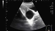 Ultrasound Video showing an large Ovarian Cyst.