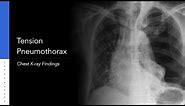 Tension Pneumothorax: Explanation of Chest X-ray Findings