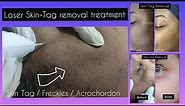 Skin Tag Removal /Mole Removal / Wart /Acrochordon/ Plasma Pen treatment / Medic clinic near LPU
