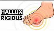 Hallux Rigidus: The Stiff Big Toe Condition and Treatment Options