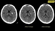 Stages of intra-cerebral hemorrhage in CT