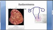 Pathology 747 b DysGerminoma tumor microscopy histology gross