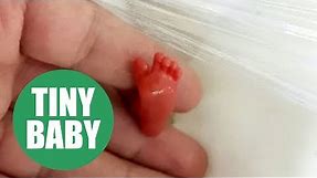 One of the world's smallest babies ever to survive
