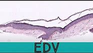 Epidermodysplasia Verruciformis (EDV) variant of flat wart verruca plana (pathology dermpath)
