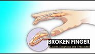 Broken finger, Causes, Signs and Symptoms, Diagnosis and Treatment.
