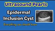 Ultrasound Pearls: Epidermal inclusion cyst