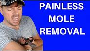 BEST WAY TO REMOVE MOLES | SKIN TAGS TOO! | Chris Gibson