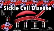 Sickle Cell Disease, Animation
