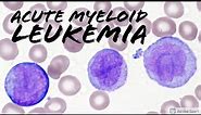 Acute Myeloid Leukemia (AML) w/ Monocytic Differentiation (formerly AMML) with Blasts & Promonocytes