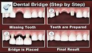 Dental Bridge Procedure Step by Step