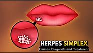 Herpes Simplex, Causes, Signs and Symptoms, Diagnosis and Treatment.