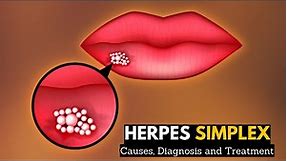 Herpes Simplex, Causes, Signs and Symptoms, Diagnosis and Treatment.