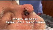 Nose Basal Cell Carcinoma treated with Moh's Surgery