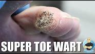 EXTRA LARGE TOE WART REMOVAL