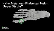 Hallux Metatarsal-Phalangeal Fusion Video (MPJ) - Super Staple™
