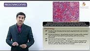 Vascular tumors - Angiosarcoma - Definition, Epidemiology, Pathology, Diagnosis and treatment