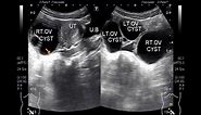 Ultrasound Video showing multiple Ovarian Cysts.