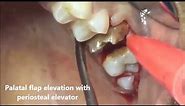 Root stump of molar extraction using periosteal elevator