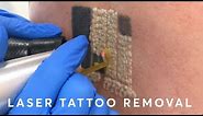 Laser Tattoo Removal: PAIN, RESULTS & PROCEDURE