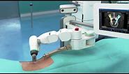 Robotic spine surgery with Mazor X